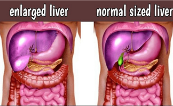 foods to avoid with enlarged liver